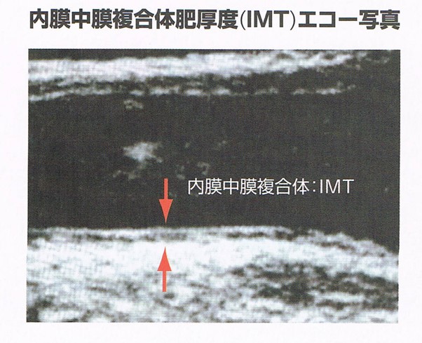 頸動脈エコー検査