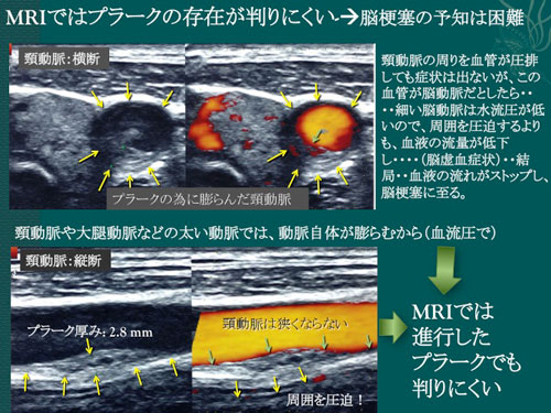 頸動脈エコーの特徴